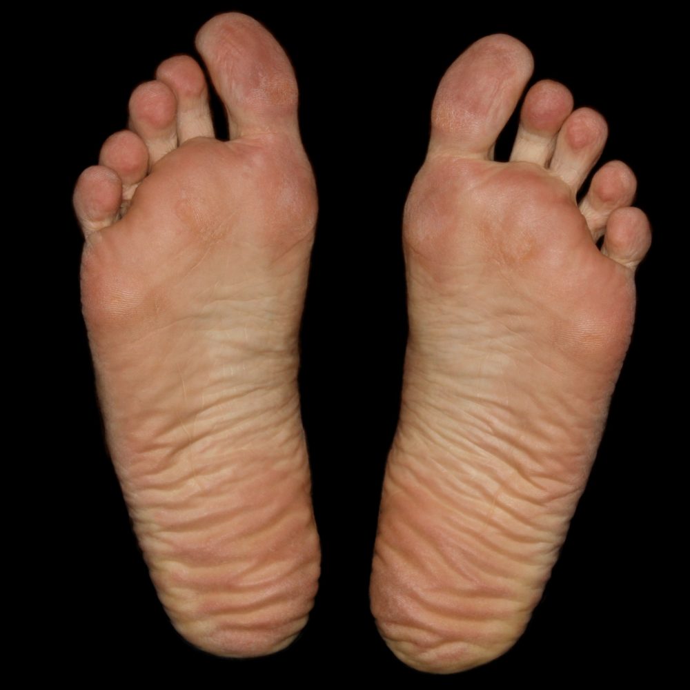 Diabetic Foot Care